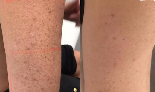 skin brightening melasma before after mississauga oakville